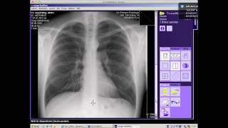 Webinar Röntgenthorax  Basics 1 [upl. by Carita]