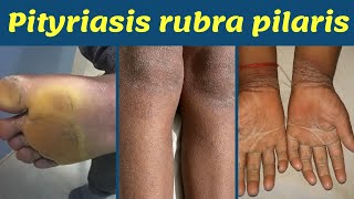 Pityriasis rubra pilaris Thick palmsole cause amp treatment  पाँवहाथ का चमड़ी मोटा होना Dr Uttam [upl. by Waiter]