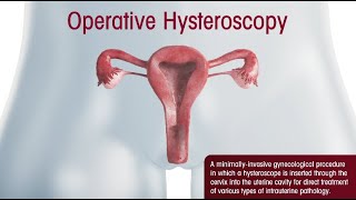 Operative Hysteroscopy Procedural Overview [upl. by Endo192]