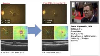 Principles of Subthreshold MicroPulse Laser Therapy for Retinal Disorders [upl. by Attoynek]