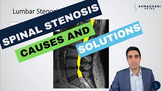 Lumbar Spinal Stenosis  What is the cause and how will I get better [upl. by Angle134]