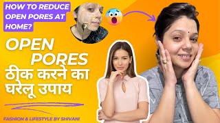 Open Pores हटाने का घरेलू उपाय  Open Pores Removal Home Remedy  Open Pores Treatment [upl. by Kelwin]