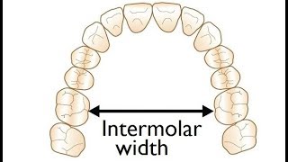 Measurement of Intermolar Width on a Model for Orthodontic Treatment by Dr Mike Mew [upl. by Accemahs]