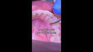 Braces  Lower permanent retainer Tartar  Tooth Time Family Dentistry New Braunfels Texas [upl. by Ettennej445]