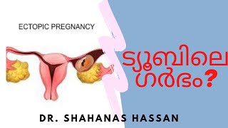 TUBAL PREGNANCY ട്യൂബല്‍ പ്രെഗ്നന്‍സി ECTOPIC PREGNANCY MALAYALAM TubalPregnancy DrShahanasHassan [upl. by Messing]