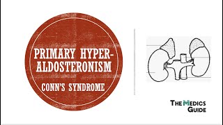 Primary Hyperaldosteronism Conns Syndrome [upl. by Jairia]