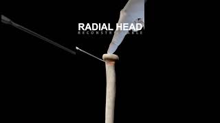 Radial head fracture fixed by screws [upl. by Nilrak]