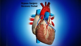 Bypass Surgery Recovery Period [upl. by Forrer27]