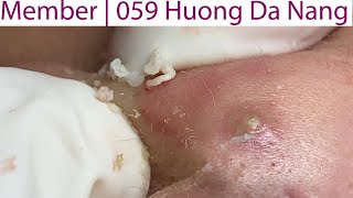 Acne Treatment Huong Da Nang 059  Member [upl. by Naujud985]