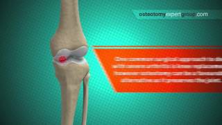 Osteotomy Animation i [upl. by Allerym]