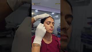 PICO Laser technology picolaser laser skincare pigmentation beauty pico fillers botox yt [upl. by Ciapha155]