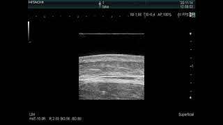 Dermatology Echo callosity after vaccination against varicella 皮膚科エコー水疱瘡ワクチン接種後の皮膚の硬結 獣医師本人） [upl. by Eillek234]