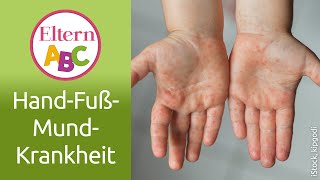 HandFußMundKrankheit  Kleinkind  Eltern ABC  ELTERN  Elternratgeber [upl. by Anirrehs]