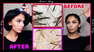 Exfoliating My Scalp Under A Microscope  Scalp Detox Treatment Before amp After INSANE [upl. by Noived886]