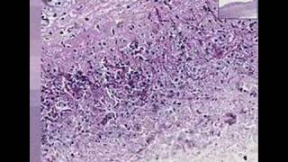 Histopathology Colon esophagus Candidiasis [upl. by Marie-Ann756]