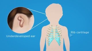 Microtia Surgery For Ear Reconstruction [upl. by Glen]