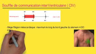 Souffle de la communication interventriculaire quotCIVquot  infos à retenir  audio [upl. by Sualk]