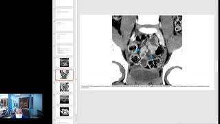 Primary Mesenteric Adenitis Imaging [upl. by Annayr]