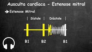 Ausculta cardiaca estenose mitral e insuficiencia mitral [upl. by Valerio709]