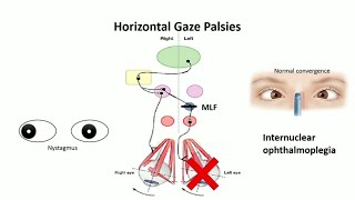 horizontal gaze palsy conjugate horizontal gaze  pathway [upl. by Sacrod667]