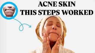 EFFECTIVE SOLUTION FOR ACNE amp DARK SPOTS  SKINCARE ROUTINE  Simple and affordable [upl. by Ricky]