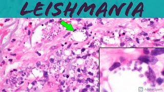 Leishmaniasis Leishmania Infection 5Minute Pathology Pearls ‪Dermatology Dermatopathology [upl. by Acirretahs]