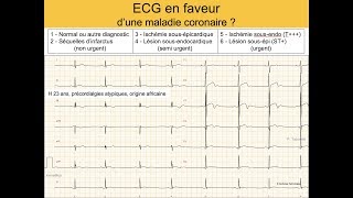 Infarctus ou variante rare africaine de repolarisation  Quiz ECG Dr Taboulet [upl. by Sukhum]