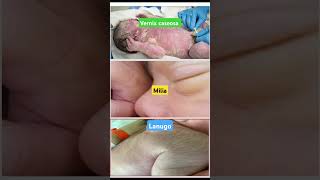 Lanugo vs vernix caseosa and miliamedicine medicaldepartures drugeducation medicalstudent [upl. by Audres]