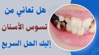 هل تعاني من تسوس الأسنان ؟ هذا الفيتامين هو الحل  The quick solution to the problem of tooth decay [upl. by Nona]