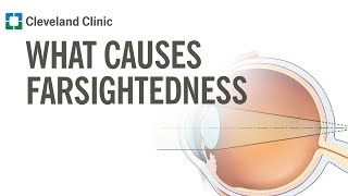 Difference between Myopia Near Sightedness amp Hyperopia FarSightedness [upl. by Cochard937]