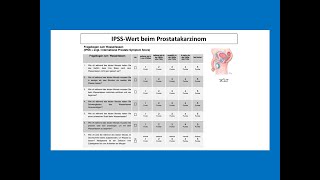 IPSSWert beim Prostatakarzinom  Strahlentherapie Prof Hilke Vorwerk [upl. by Enelhtak518]