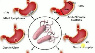 PATHOLOGY LECTURES  Gastrointestinal  CHRONIC GASTRITIS [upl. by Bouzoun]