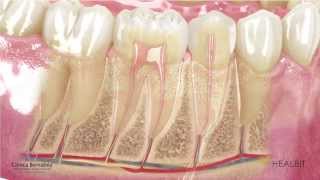 Qué es una endodoncia [upl. by Rudolfo]