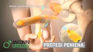 Disfunzione erettile  Antonini Urology Urologo amp Andrologo Roma [upl. by Bray459]