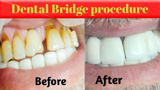 fixed dental bridge before and after [upl. by Ettenay229]