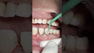 Class V composite restoration dental dentist [upl. by Nadabb230]