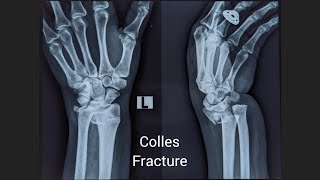 Colles Fracture by Dr Bone [upl. by Vonnie]