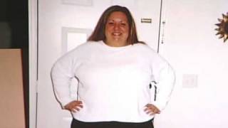 WeightLoss Surgery Success Story [upl. by Mapes497]