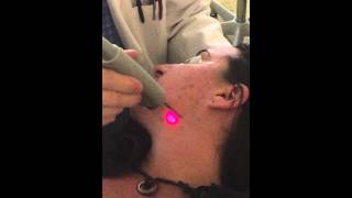 Fotona SP Dynamis Laser Treatment of Acne [upl. by Veronike]