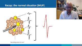 Needle EMG normal vs myopathic MUPs [upl. by Franny]