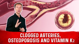 Clogged Arteries Osteoporosis and Vitamin K2 – Dr Berg [upl. by Naesad359]