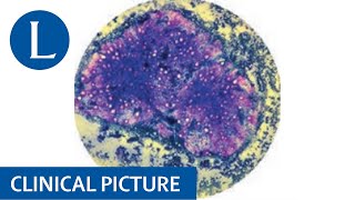 Severe anorexia nervosa and pancytopenia [upl. by Inan]