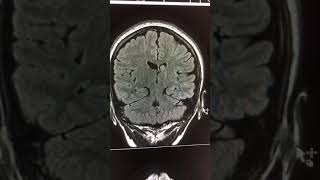 Mesial temporal sclerosis [upl. by Margaretta]