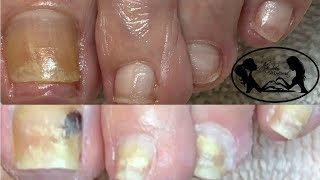 Pedicure Tutorial How to Safely Cut Toenails Fungus Cure Update✔️ [upl. by Rome]