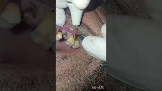 جير الاسنان ادى لانحسار اللثة  تنظيف  dentist stitch [upl. by Euqcaj447]