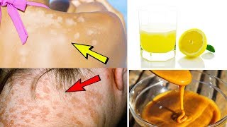 5 Effective Home Remedies For Treating Tinea Versicolor – Home Treatment Of Tinea Versicolor [upl. by Eiryt]