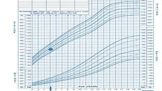 How will you know child is hypo or hypertensive  Plotting BP on centile chartAt a GLANCE [upl. by Gilcrest]