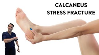 Does shockwave treatment help a calcaneus stress fracture heal [upl. by Else]