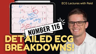 Improve your EKG Skills test yourself  ECG No 116 [upl. by Nwaf]