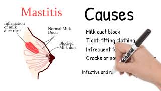 Mastitis  Breast pain during lactation or pregnancy Mastitis symptoms and treatment [upl. by Olwena]